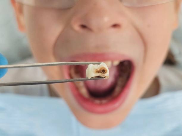 Best Emergency Wisdom Teeth Removal in West University Place, TX